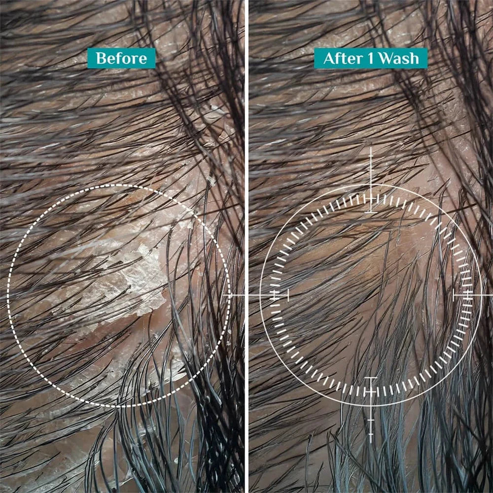 Australian Tea Tree Non-Drying Anti-Dandruff Shampoo