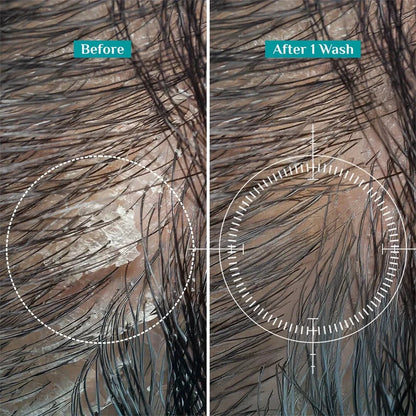 Australian Tea Tree Non-Drying Anti-Dandruff Shampoo