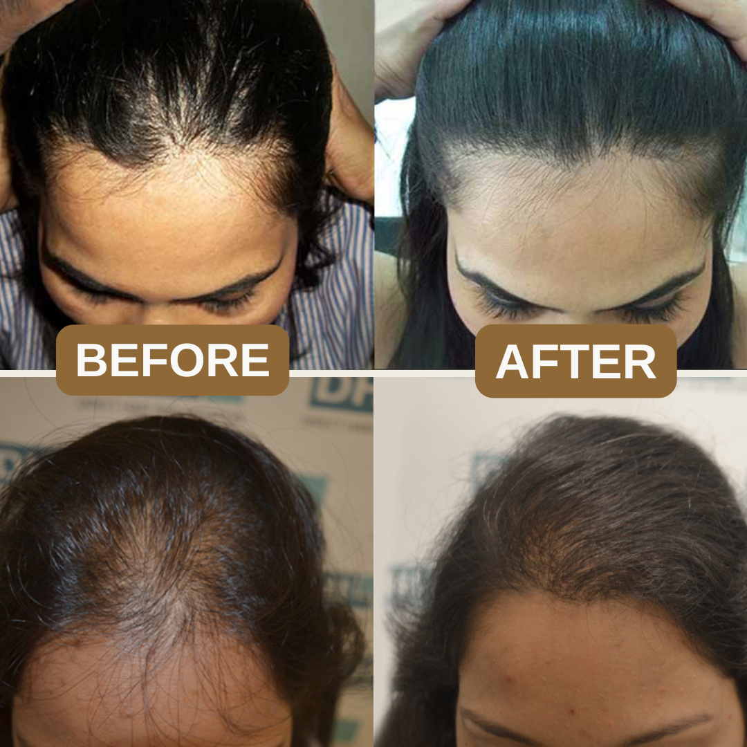 Natural Anti-Hair Fall Treatment Shampoo (Buy 1 Get 1 Free)