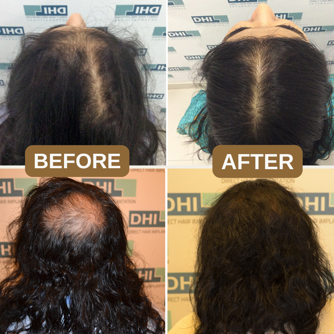 Natural Anti-Hair Fall Treatment Shampoo (Buy 1 Get 1 Free)