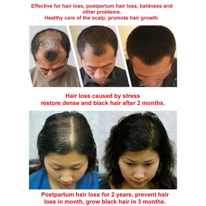 Natural Anti-Hair Fall Treatment Shampoo (Buy 1 Get 1 Free)